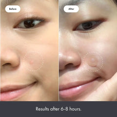 "Acne Treatment Patch Stickers for Chin, Blemish Spot Face Repair, Waterproof Skin Care - 36 Patches"