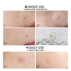 36 Patches Acne Pimple Patch Face Invisible Stickers Quick Effect Treatment Removing Patches Beauty Acne Tools Face Skin Care